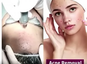 Acne Extraction (36Play)